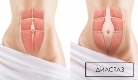 Диастаз прямых мышц живота